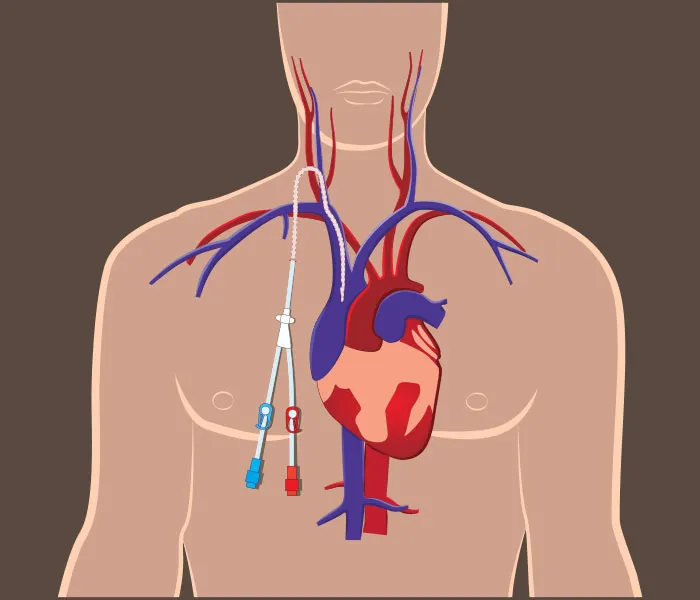 Permcath Insertion for Hemodialysis in Chandigarh