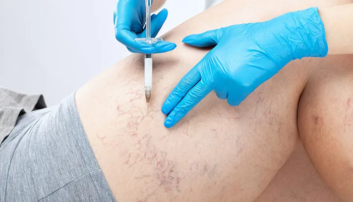 Sclerotherapy in chandigarh