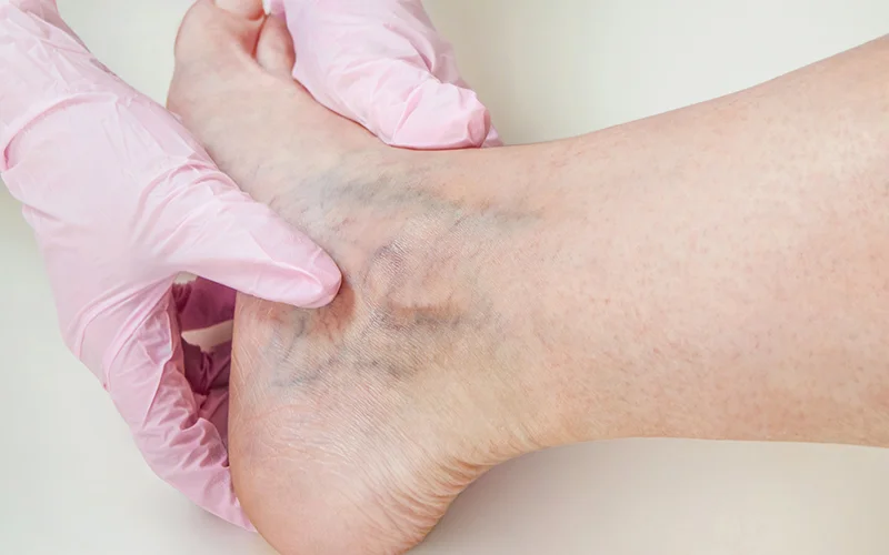 Varicose Vein Treatment in chandigarh